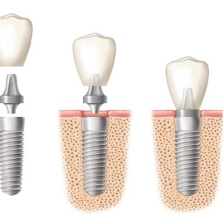 diagram of the components of a dental implant