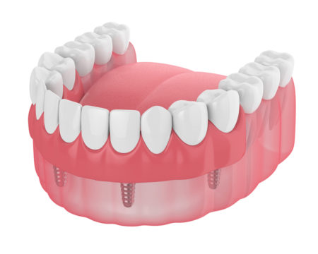 an illustration of an implant overdenture