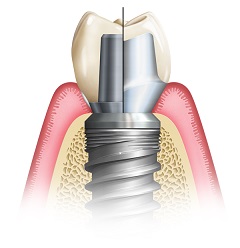diagram of dental implant with stock versus custom abutment