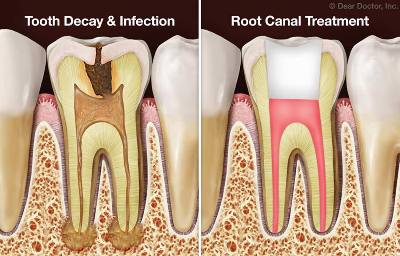 before and after root canal treatment