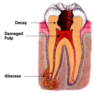 an illustration of an infected tooth before root canal treatment