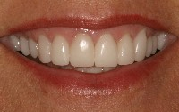 a patient's smile after porcelain crowns
