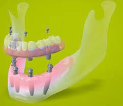 an illustration of all-on-four dental implants