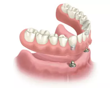 illustration of a snap-on affordable dental implant denture
