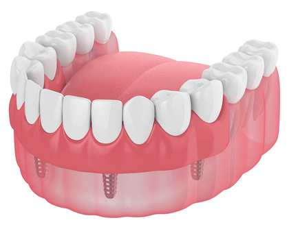 Model of an implant denture, available in Chandler, AZ from Dr. William Walden