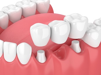 an illustration of a dental bridge held above two prepared teeth as part of full mouth reconstruction