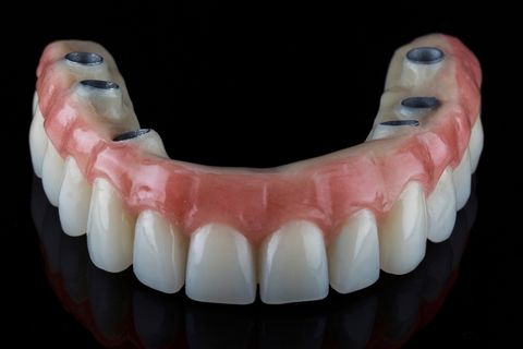Upper implant overdenture available in Chandler, AZ from Dr. William Walden