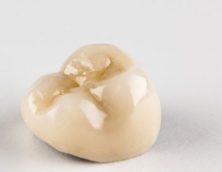 A dental crown for a molar tooth, possible treatment for a cracked tooth.