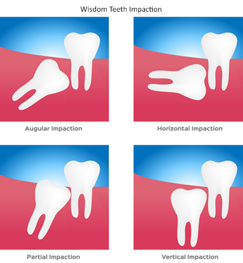 Diagram of types of wisdom teeth impaction
