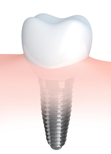 A single dental implant with gums around the dental crown, as the last alternative for an abscessed tooth