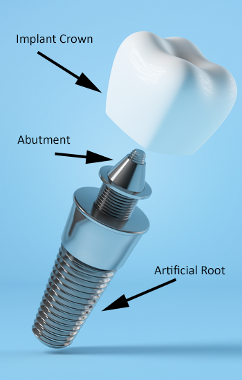 Dental implant with implant crown, abutment, and artificial root labeled