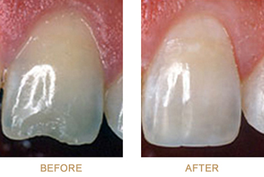 Before and after dental bonding pictures on front teeth