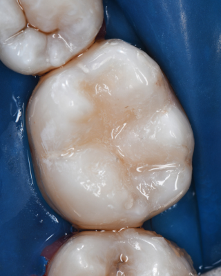 A composite tooth cavity filling for a lower tooth